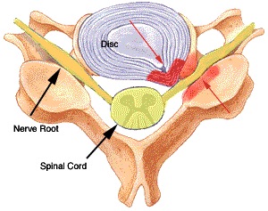 lumbar foraminotomy