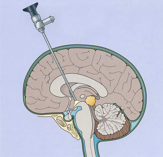 hydrocephalus ventriculostomy